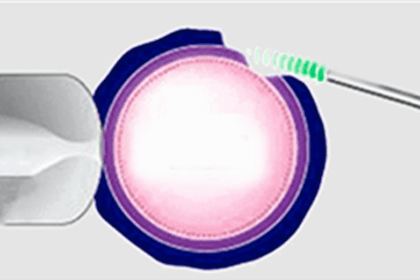 Laser Assisted Hatching