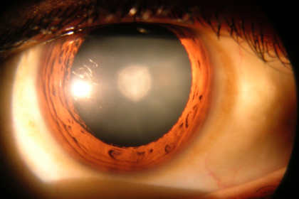 Cataract eye disease showing cloudy lens causing blurred vision
