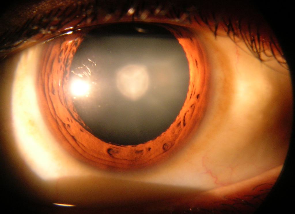 Cataract eye disease showing cloudy lens causing blurred vision