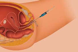 ਆਈਯੂਆਈ ਇਲਾਜ